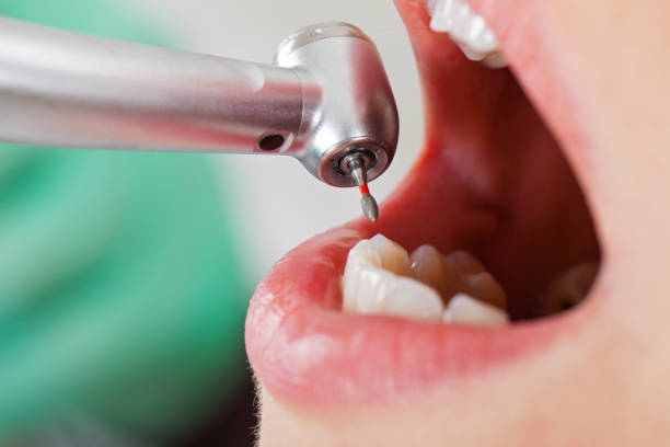 Best Emergency Tooth Extraction in Fairfax, IA